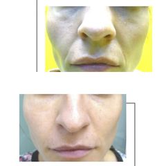 Rellenos faciales - Clinica Renobell