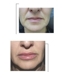 Aumento de labios - Clinica Renobell