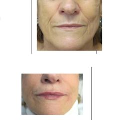 Aumento de labios - Clinica Renobell