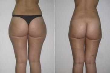 Antes y después Liposucción