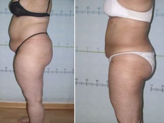 Antes y después Liposucción