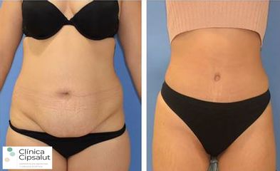 Abdominoplastia - Clínica Cipsalut