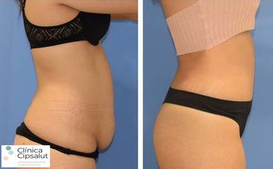 Abdominoplastia - Clínica Cipsalut