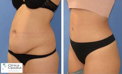Abdominoplastia - Clínica Cipsalut