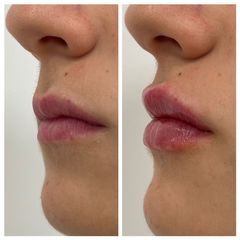 Aumento de labios - Clínica Cipsalut