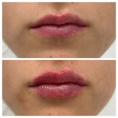 Aumento de labios - Clínica Cipsalut