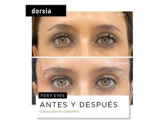 Hilos tensores antes y después - 701980