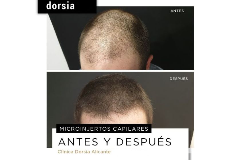 Microinjertos antes y después - 701995