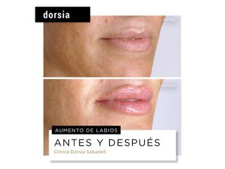 Aumento de labios - Dorsia Clinicas De Estética