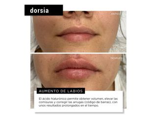 Aumento de labios - Dorsia Clinicas De Estética