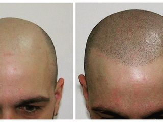 Antes y después micropigmentación 