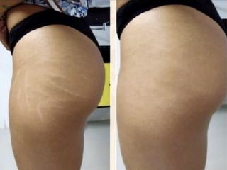 Antes y después camuflaje estrias 