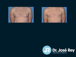 Ginecomastia - Dr. José Rey Vasalo