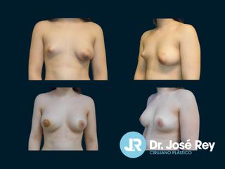 Mastopexia - Dr. José Rey Vasalo