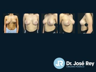 Mastopexia - Dr. José Rey Vasalo