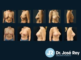 Aumento de pecho - Dr. José Rey Vasalo