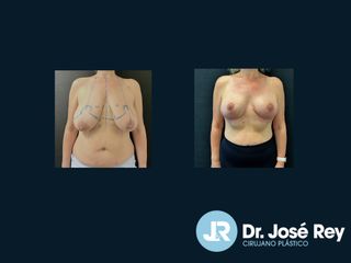 Reducción senos - Dr. José Rey Vasalo