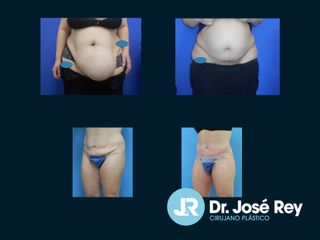 Abdominoplastia - Dr. José Rey Vasalo