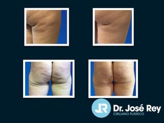 Liposucción - Dr. José Rey Vasalo