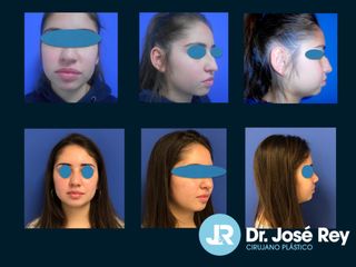 Rinoplastia - Dr. José Rey Vasalo