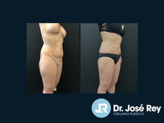 Liposucción - Dr. José Rey Vasalo