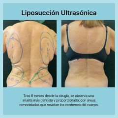 Liposucción