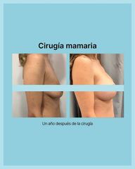 Cirugía Mamaria
