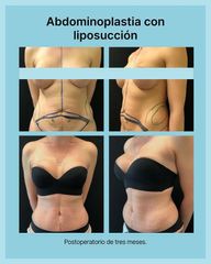 Abdominoplastia con Liposucción