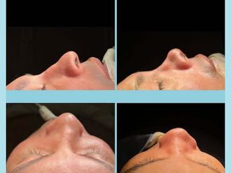 Rinoplastia antes y después - 876662