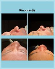 Rinoplastia