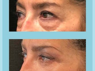 Blefaroplastia antes y después - 876663