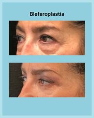 Blefaroplastia