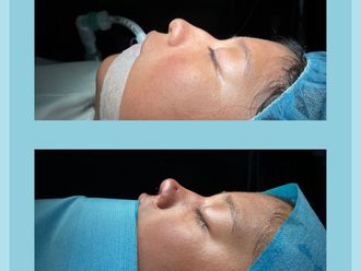 Rinoplastia antes y después - 876666
