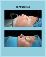 Rinoplastia