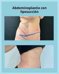 Abdominoplastia con Liposucción