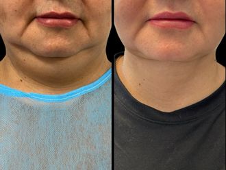 Lifting sin cirugía antes y después - 878584