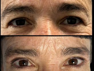 Blefaroplastia antes y después - 878586