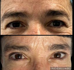 Labrum Blefaroplastia