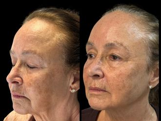 Ácido hialurónico antes y después - 878587