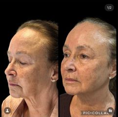 Labrum - Ácido Hialurónico