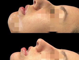 Rinomodelación antes y después - 878588