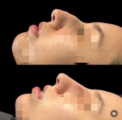 Labrum - Rinomodelación