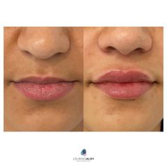 Aumento de labios - Dra. Lourdes Aloy