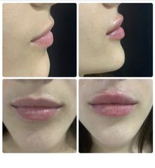 Aumento de labios - Clínica Sansara