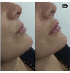 Aumento de labios  - Clínica Sansara