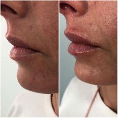 Aumento de labios - Clínica Sansara