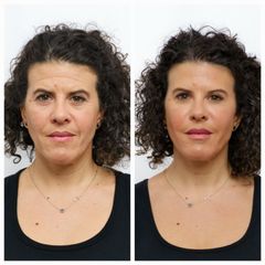 Clínica Carlos Gómez - Rejuvenecimiento facial