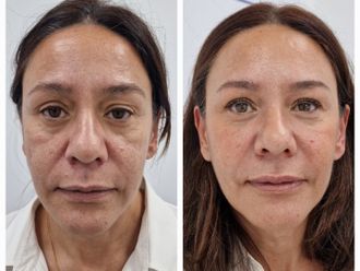 Rejuvenecimiento facial antes y después - 876476
