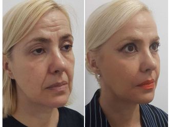 Rejuvenecimiento facial antes y después - 876478
