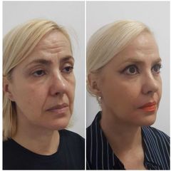 Clínica Carlos Gómez - Rejuvenecimiento facial